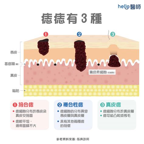 長痣原因|為什麼會突然長痣？痣長毛是什麼原因？一次瞭解痣與。